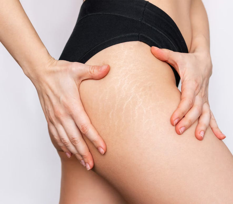 Stretch Marks